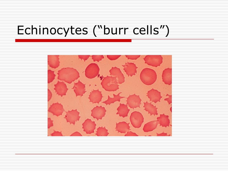 Echinocytes (“burr cells”)